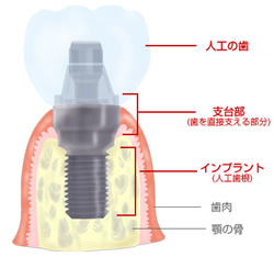 implant-1.jpg