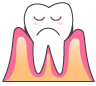 軽度の歯周病